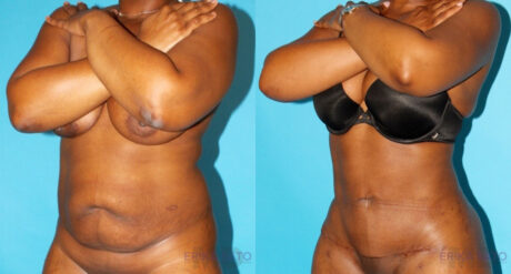 Tummy Tuck case #7168