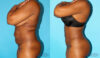 Tummy Tuck case #7168 slider thumbnail