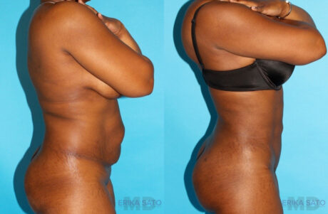 Tummy Tuck case #7168