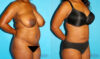 Liposuction case #5888 slider thumbnail