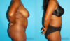 Liposuction case #5888 slider thumbnail