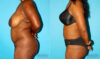 Liposuction case #5888 slider thumbnail
