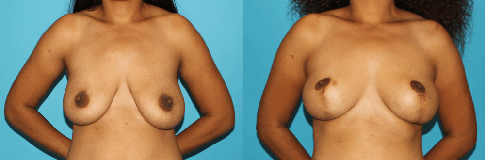 Breast Lift case #6977