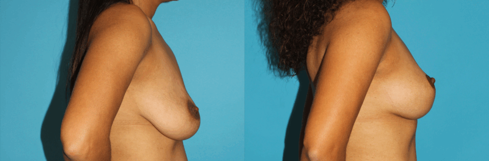 Breast Lift case #6977