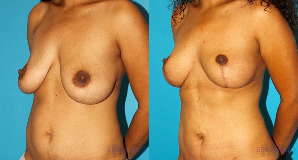 Breast Lift case #6977
