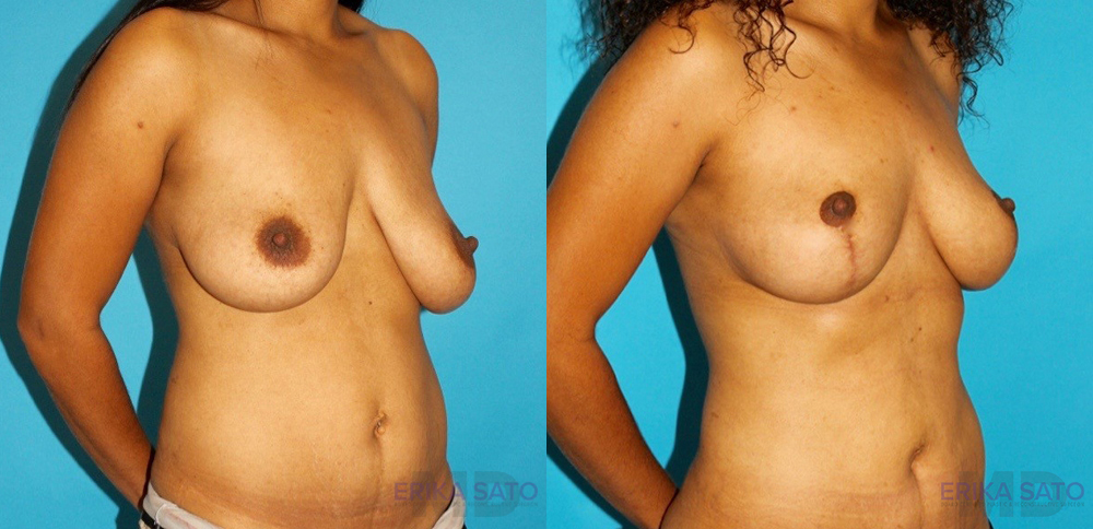 Breast Lift case #6977