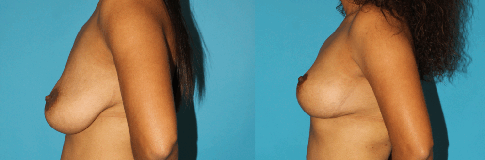 Breast Lift case #6977