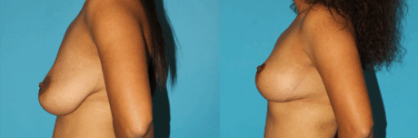Breast Lift case #6977