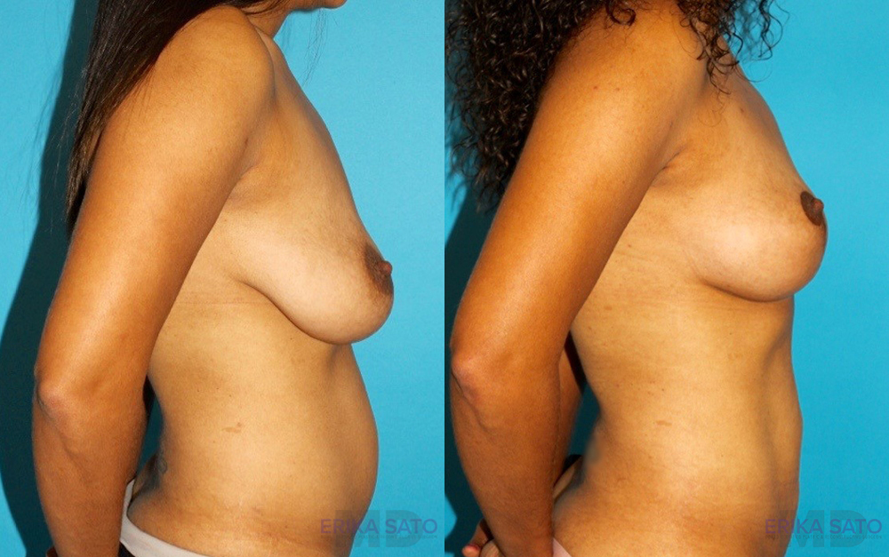 Breast Lift case #6977
