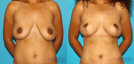 Breast Lift case #6977