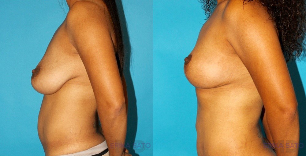 Breast Lift case #6977