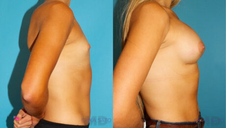 Breast Augmentation case #5626