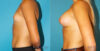 Breast Augmentation case #5626 slider thumbnail
