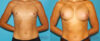 Breast Augmentation case #5626 slider thumbnail