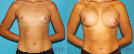 Breast Augmentation case #5626