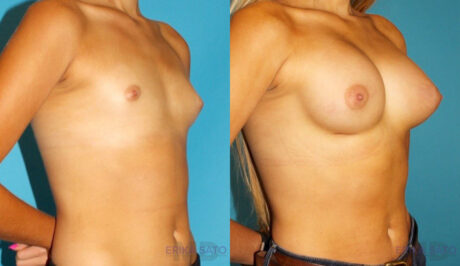 Breast Augmentation case #5626