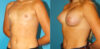 Breast Augmentation case #5626 slider thumbnail