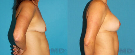 Breast Lift with Implants case #7872