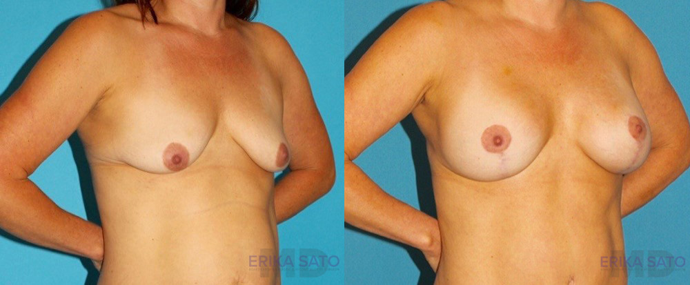Breast Lift with Implants case #7872