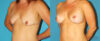 Breast Lift with Implants case #7872 slider thumbnail