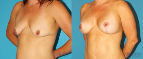 Breast Lift with Implants case #7872