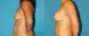 Breast Lift with Implants case #7872 slider thumbnail