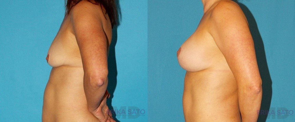 Breast Lift with Implants case #7872