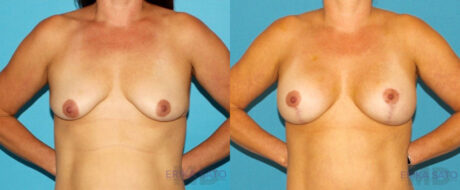 Breast Lift with Implants case #7872