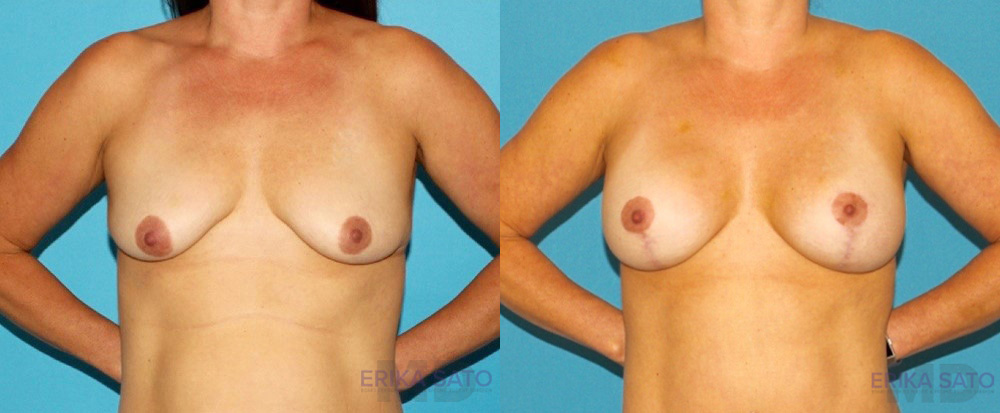 Breast Lift with Implants case #7872