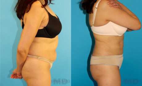 Liposuction case #5887