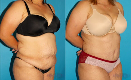 Tummy Tuck case #7167