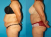 Tummy Tuck case #7167 slider thumbnail