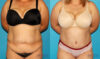 Tummy Tuck case #7167 slider thumbnail