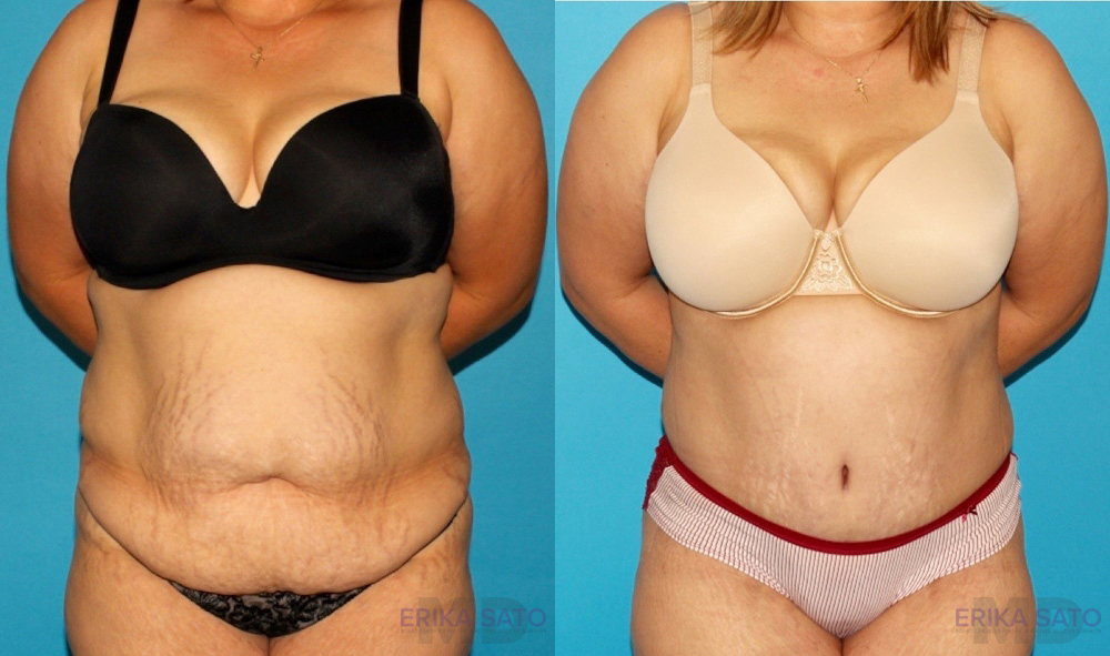 Tummy Tuck case #7167