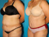 Tummy Tuck case #7167 slider thumbnail