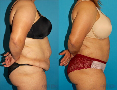 Tummy Tuck case #7167