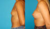 Breast Augmentation case #5672 slider thumbnail