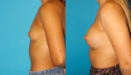 Breast Augmentation case #5672