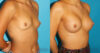 Breast Augmentation case #5672 slider thumbnail