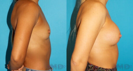 Breast Augmentation case #5672