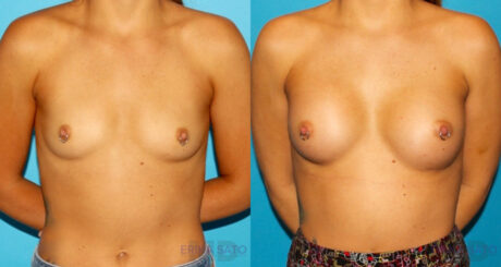 Breast Augmentation case #5672
