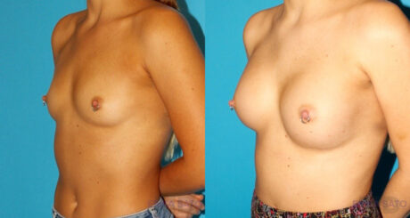 Breast Augmentation case #5672