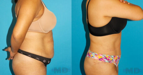 Tummy Tuck case #7274