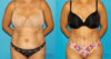 Tummy Tuck case #7274 slider thumbnail