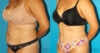 Tummy Tuck case #7274 slider thumbnail