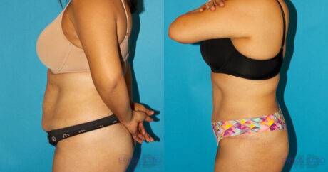 Tummy Tuck case #7274