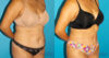 Tummy Tuck case #7274 slider thumbnail