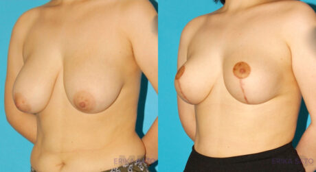 Breast Reduction case #7956