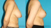 Breast Reduction case #7956 slider thumbnail