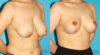 Breast Reduction case #7956 slider thumbnail